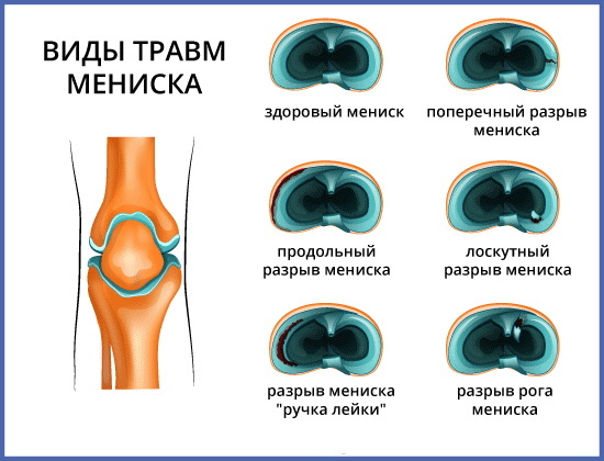 Rupture of the knee meniscus. Symptoms and Treatment