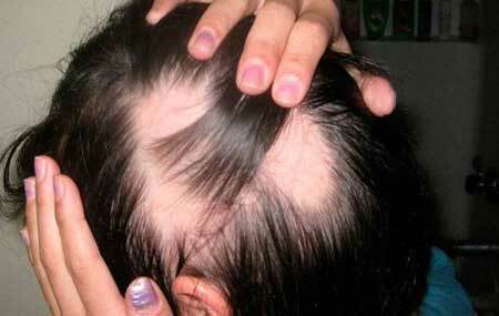 Alopecie co je to