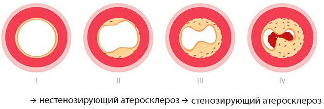 Ikke-stenotisk aterosklerose af BCA (brachiocephalic arteries)