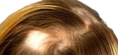 Ohnisková( alimentární) alopecie