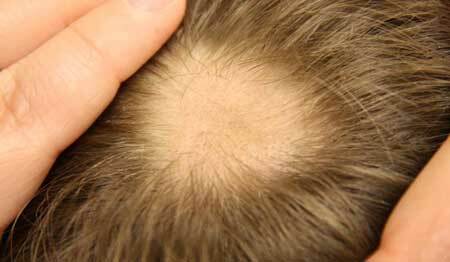 alopecie areata u žen