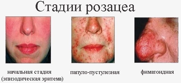 Solantra for rosacea. Instructions for use, price, reviews