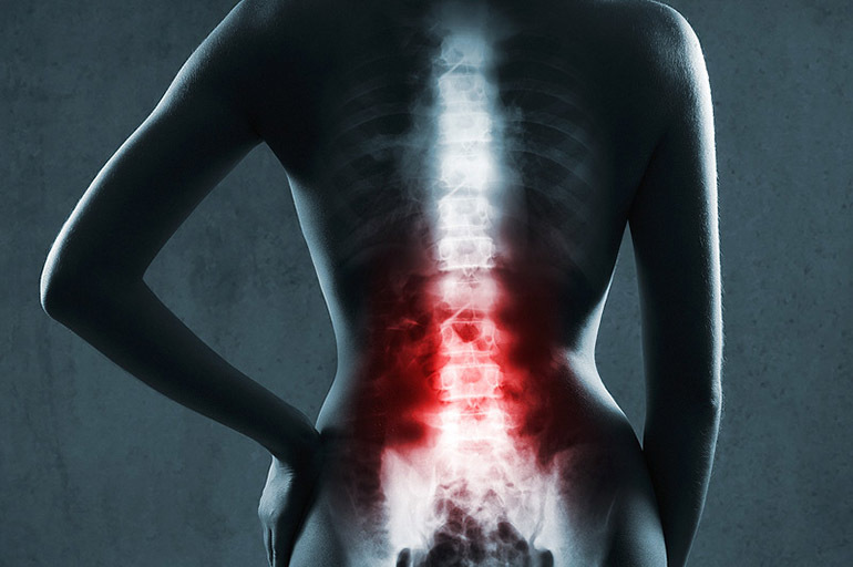 Spinal tuberkulos: beskrivning, orsaker, symptom