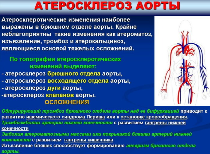 Ateroskleróza aorty srdca. Čo to je, čo znamená tesnenie steny?