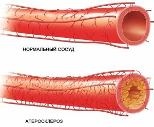 Kraujagyslių aterosklerozė