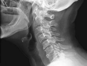 X-ray beeld van cervicale spondylose