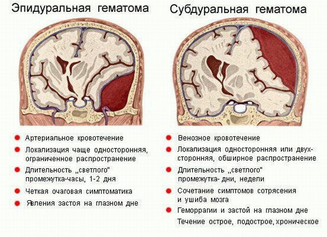rozdíl mezi hematomy mozku