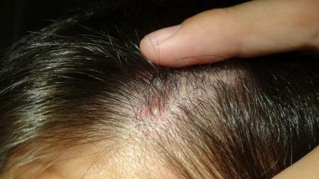 Why does acne appear on my head?