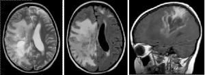 MRI mozga