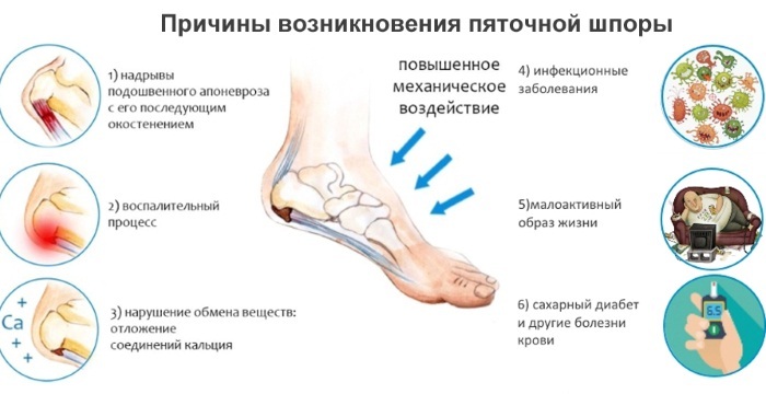 Inflammation av nerven i benet i foten. Symptom och behandling