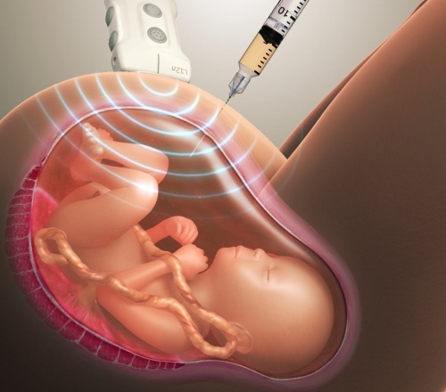 Amniocenteza med nosečnostjo. Kaj je, natančnost, kako dolgo to počnejo, posledice, kontraindikacije