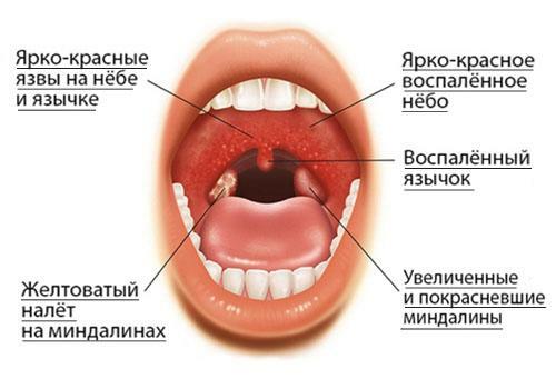 Signs of sore throat
