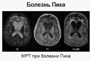 MRI s Pickovom bolešću