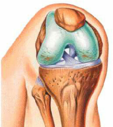 Artrosis deformante de la articulación de la rodilla
