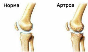 artroza kolan