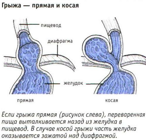Arten von Hernien der Speiseröhre