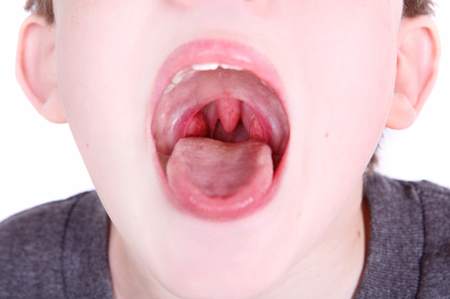 How to remove tonsils and when it is needed?