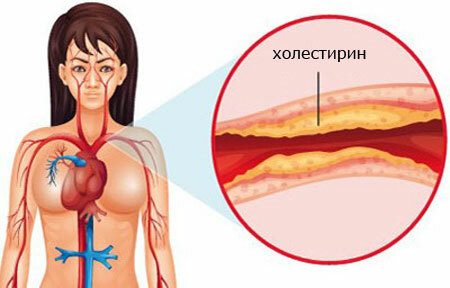 Causes of cholesterol deposition