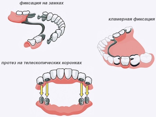 Închideți protezele pentru maxilarul inferior / superior. Fotografie pe cleme, atașamente, încuietori, atele, quadrotti