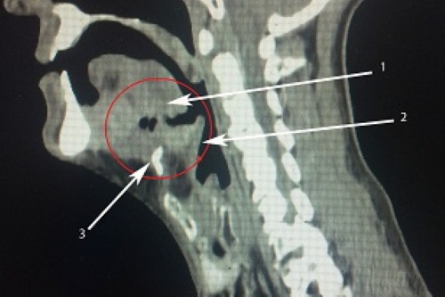 IRM de la gorge et du larynx, du pharynx, de l'œsophage. qui montre le prix