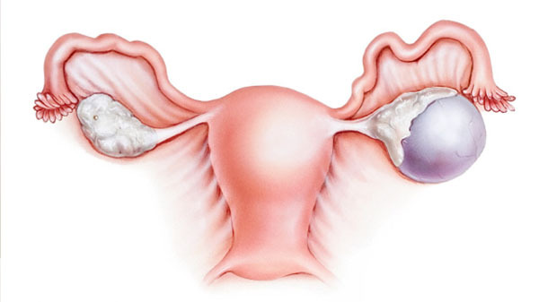 Signs of the ovarian cyst