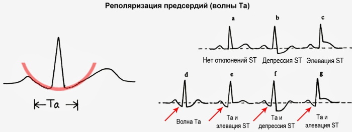 P wave (R) on the ECG. What reflects, characterizes, appears as a result of which, the norm