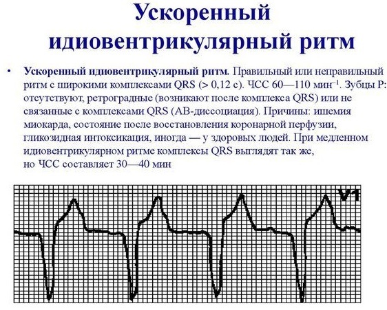 Idioventrikulaarne rütm EKG -l. Mida see tähendab, fotod, põhjused ja ravi