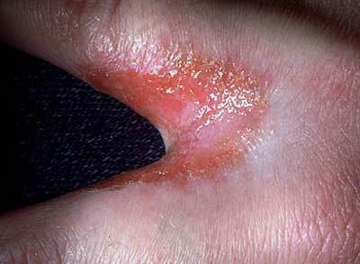 Manifestation of candidiasis between the fingers, photo 3