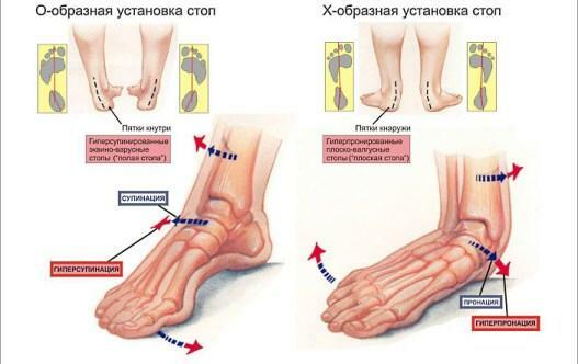 מחלות של הרגל - נוכחות של רגל שטוחה נח על כל כף הרגל, ללא הפסקה