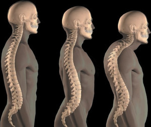Cifosi della colonna vertebrale toracica