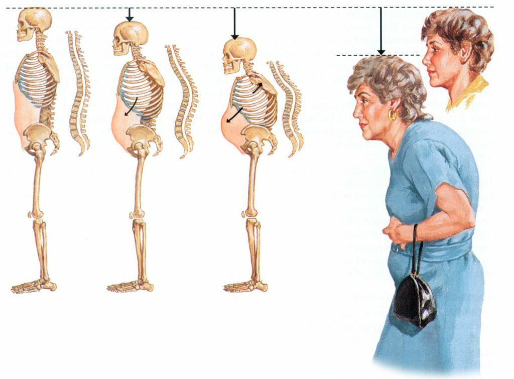 Changes in stature and posture in osteoporosis