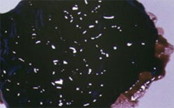 Diarree van zwarte kleur( diarree)