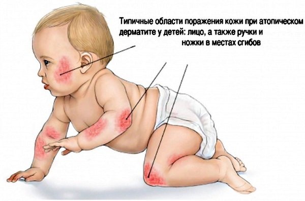 Dermatite em crianças. Imagem, sintomas e tratamento de contacto, alergia, perianal, pelonochny, atópica