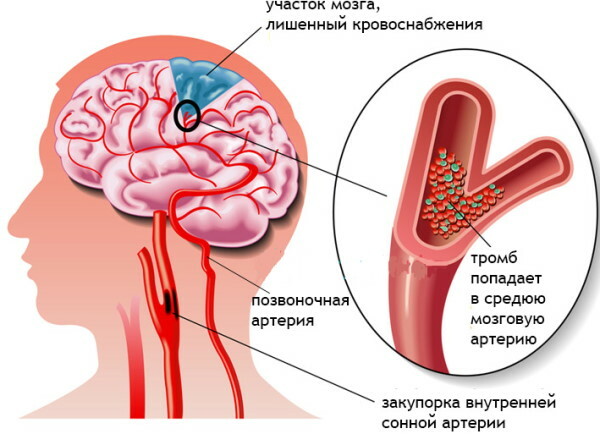 Hormetonie, sindromul hormonal al lui Davidenkov. Neurologie