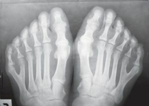 Genetic disease polydactyly of the extremities