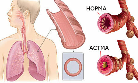 Bronchial astma: symptomer og behandling. Hvad er det?