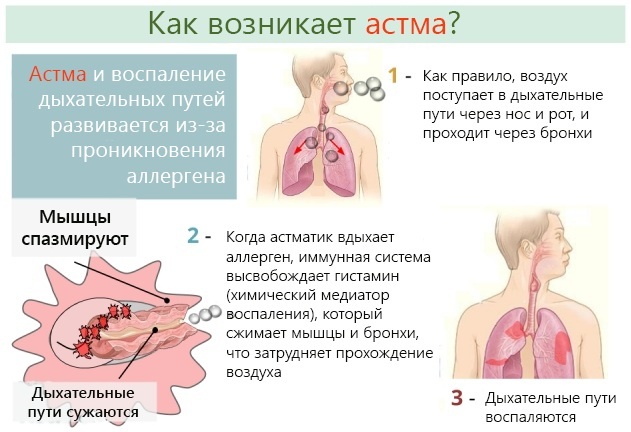 Fisioterapia para el asma bronquial en adultos, niños.