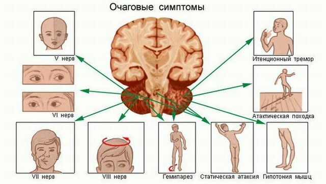 De første tegn og symptomer på en hjerne tumor - tid til at lægge mærke til for at overleve