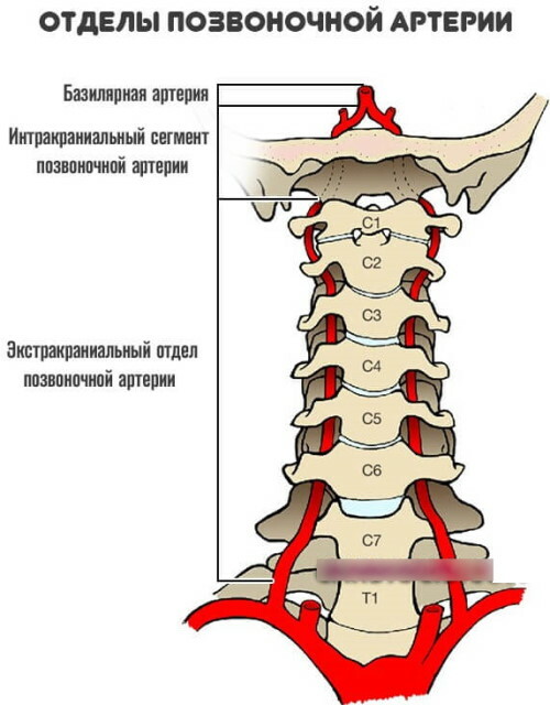 Hipoplazija desne vretenčne arterije. Kaj je to, simptomi, zdravljenje