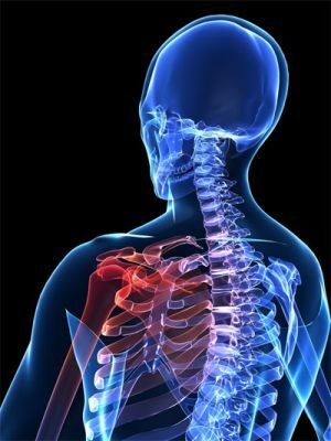 a vertebrenikus brachialgia megnyilvánulása