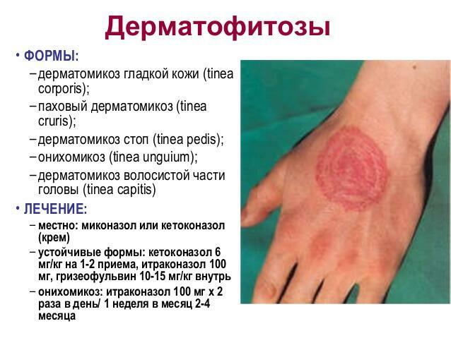 Forms and treatment of dermatomycosis