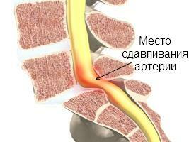 Syndrom der Arteria vertebralis