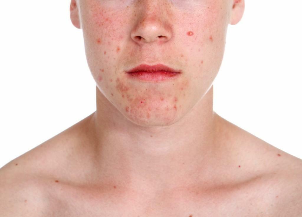 Acne as the cause of malnutrition