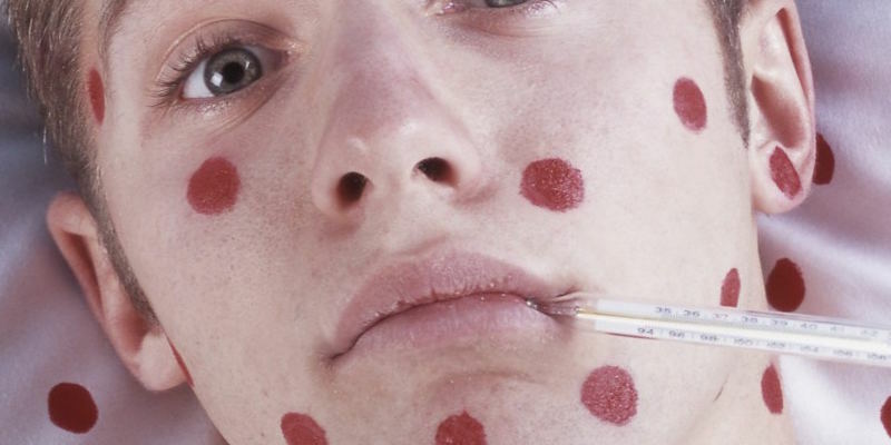 Chicken pox in adults