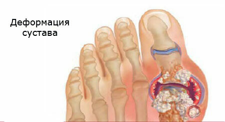 progression of gout deformity of the joint