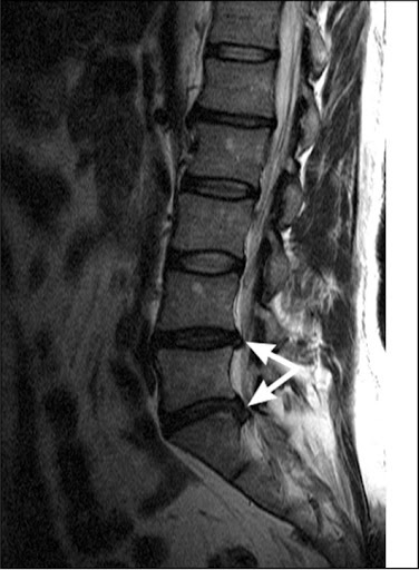 Spondylosis of the lumbosacral spine. What is it, symptoms, treatment, consequences