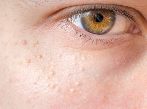 A pimple on the eyelid of the lower, upper, white eyes appeared. Treatment