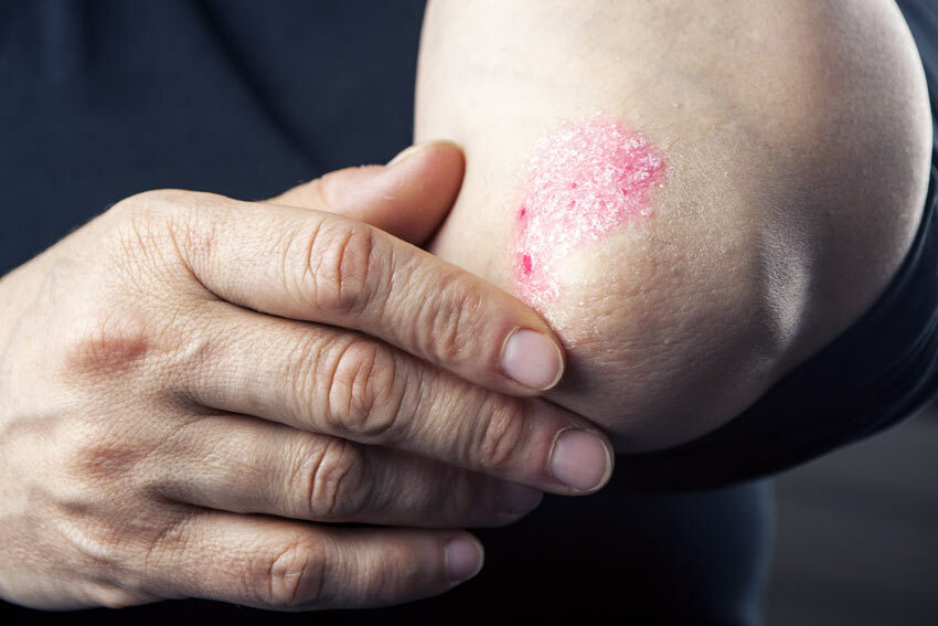 Instructions for use of the drug Psorichontrol psoriasis