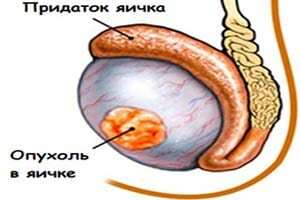 Cancerul testicular