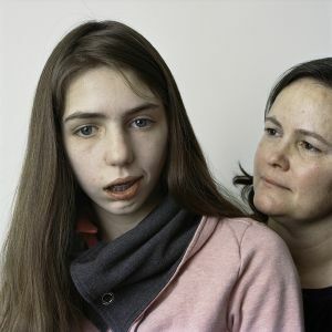 veido paralyžius su Foville sindromu